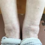 90代お婆ちゃん　脚のむくみ　足の痛み